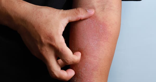 Desperate dad pleads for help with son's extreme eczema