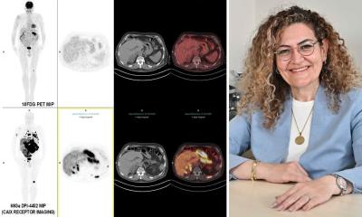 ccRCC kidney cancer: PET/CT imaging approach improves lesion detection • healthcare-in-europe.com