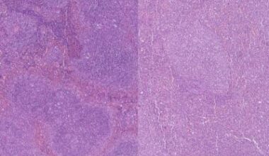 Six-gene scoring system could help predict AML survival • healthcare-in-europe.com