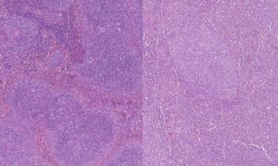 Six-gene scoring system could help predict AML survival • healthcare-in-europe.com
