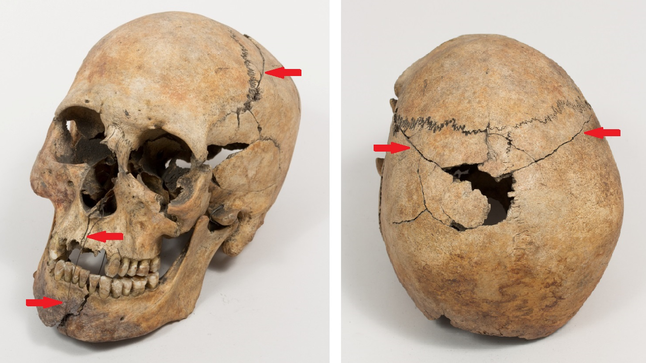 two views of a human skull showing post-mortem damage and reconstruction