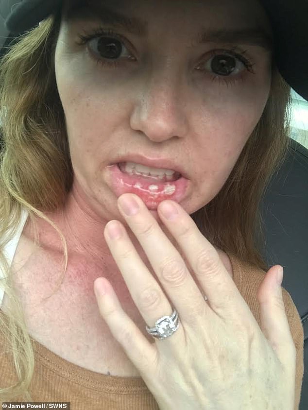 Radiation treatments led to irritated sun burned-like skin on her neck, sores in her mouth, and blisters around her lips