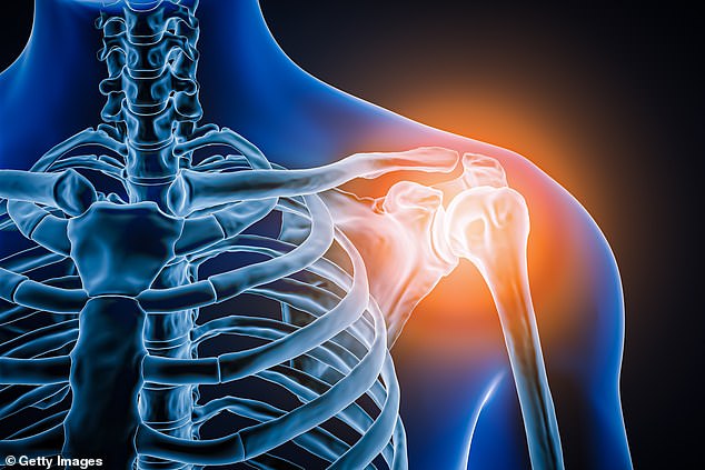Frozen shoulder, which causes pain and stiffness often brought on by an injury, can persist for months (sometimes years) and make everyday activities difficult