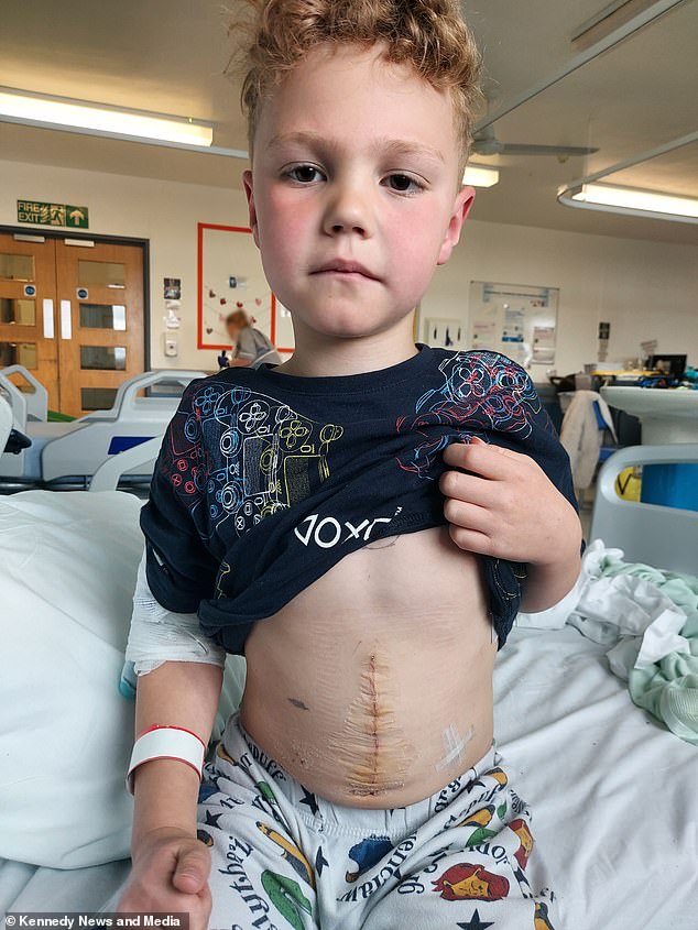 The seven-year-old boy's stitches showing where the surgeons had to make a 10-inch incision