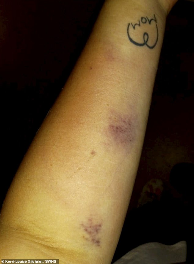 Adding that an anesthetist said Ms Gilchrist had been 'pounding on heaven's door', the mother-of-two said medical professionals were 'surprised I'm alive', adding: 'Doctors put it down as a pre-terminal event.' Pictured: Ms Gilchrist's arms following her blood transfusions