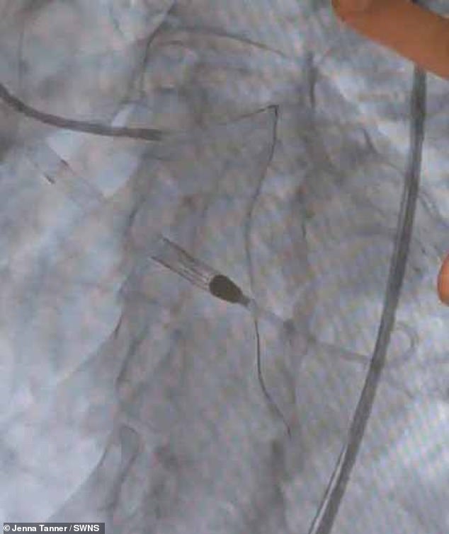 Jenna's X-ray shows a blockage in the LMCA, which supplies most of the heart muscle with life-giving blood and oxygen