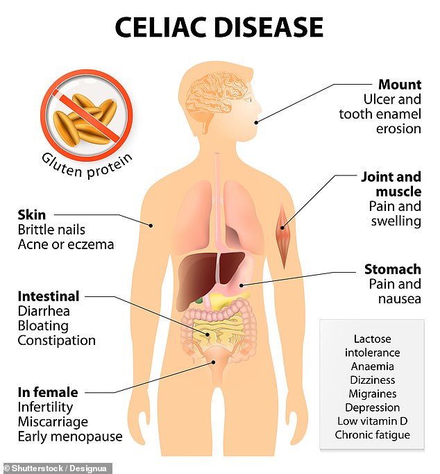 Around one in 100 people in the UK suffer coeliac disease, whereby the immune system overreacts to gluten.