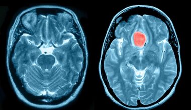 Meningioma is the most common type of brain tumour, and is most found in women