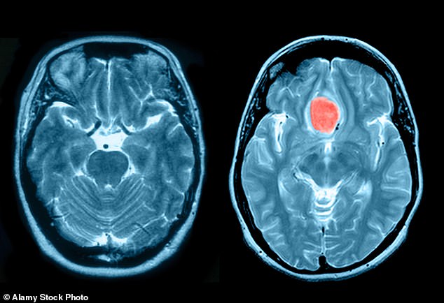 Meningioma is the most common type of brain tumour, and is most found in women