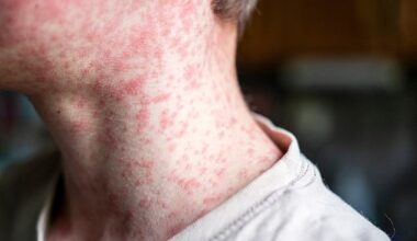 A man is understood to have contracted measles while overseas in Indonesia (stock image)