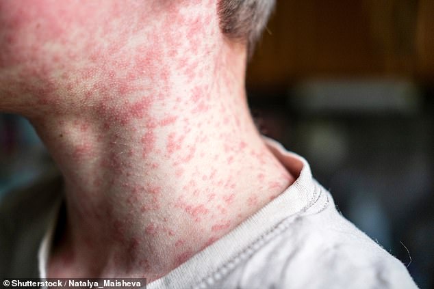 A man is understood to have contracted measles while overseas in Indonesia (stock image)