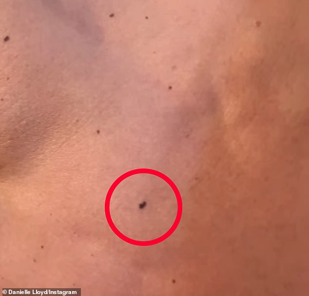 Showing off the mole she explained: 'It only looks small but it's definitely changed in colour and size'