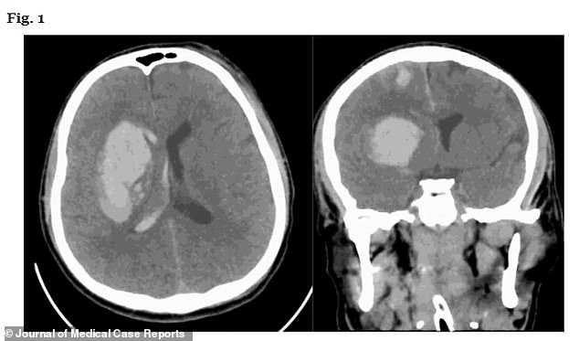 The anonymous 34-year-old was diagnosed with deadly Candidozyma auris (C. auris) almost three months after suffering a traumatic brain injury in a car crash