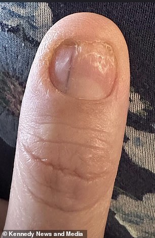 Lucy noticed a black, vertical line on her left thumb after popping off her orange, ombre acrylic nails in April 2023