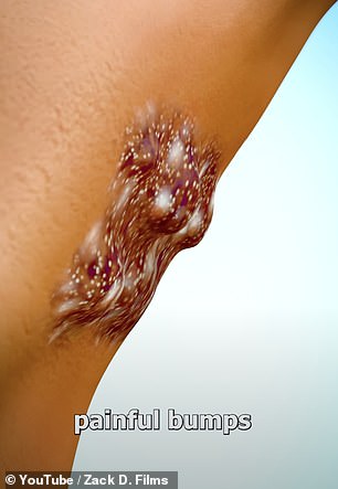 It goes on to show the painful bumps appearing under the man's armpit as he shouts out in agony