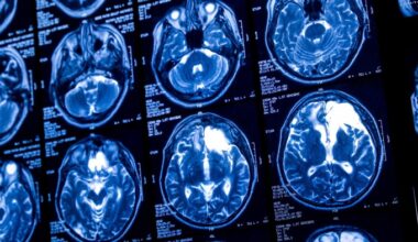 Brain scans