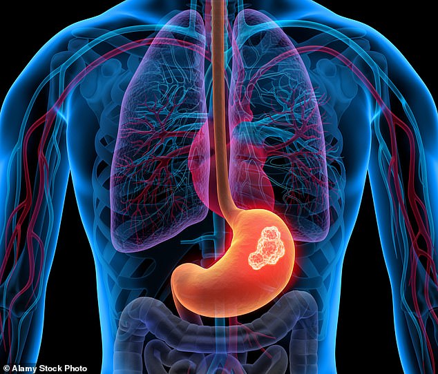 Having problems swallowing (dysphagia), feeling or being sick, heartburn or acid reflux and symptoms of indigestion, such as burping a lot, can all be signs of cancer