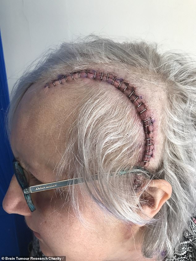 The tumour stretched from behind her left eye to the back of her head. Glenn said: 'It looked like two plums. I was shocked and horrified when doctors told me.'