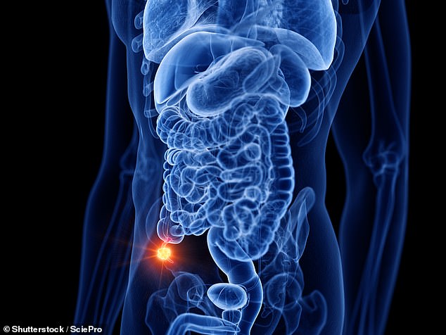 The appendix is a small pouch of tissue connected to the bowel in the lower right side of the abdomen