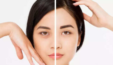 5 sure shot remedies to reduce dark circles