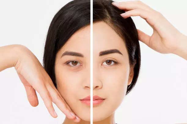 5 sure shot remedies to reduce dark circles