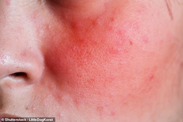 Skin disorders including dermatitis, eczema and rosacea make the problem worse by disrupting the barrier and triggering inflammation (stock photo)