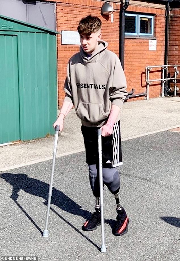 Levi was placed in a medically induced coma and underwent a double leg amputation to try and get the infection under control