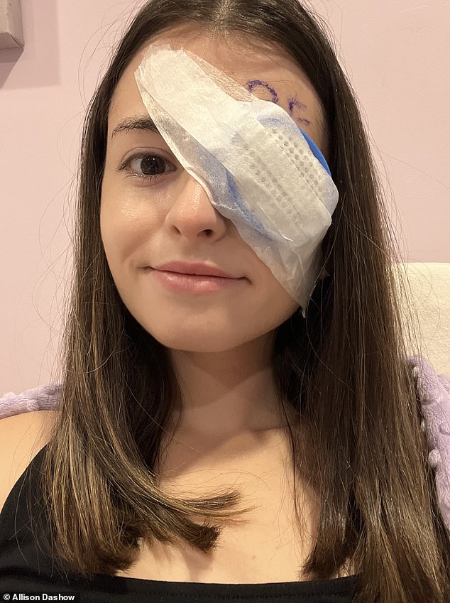 Pictured: Dashow, now 29, after her surgery with a covering over the affected eye - she wore it for seven days