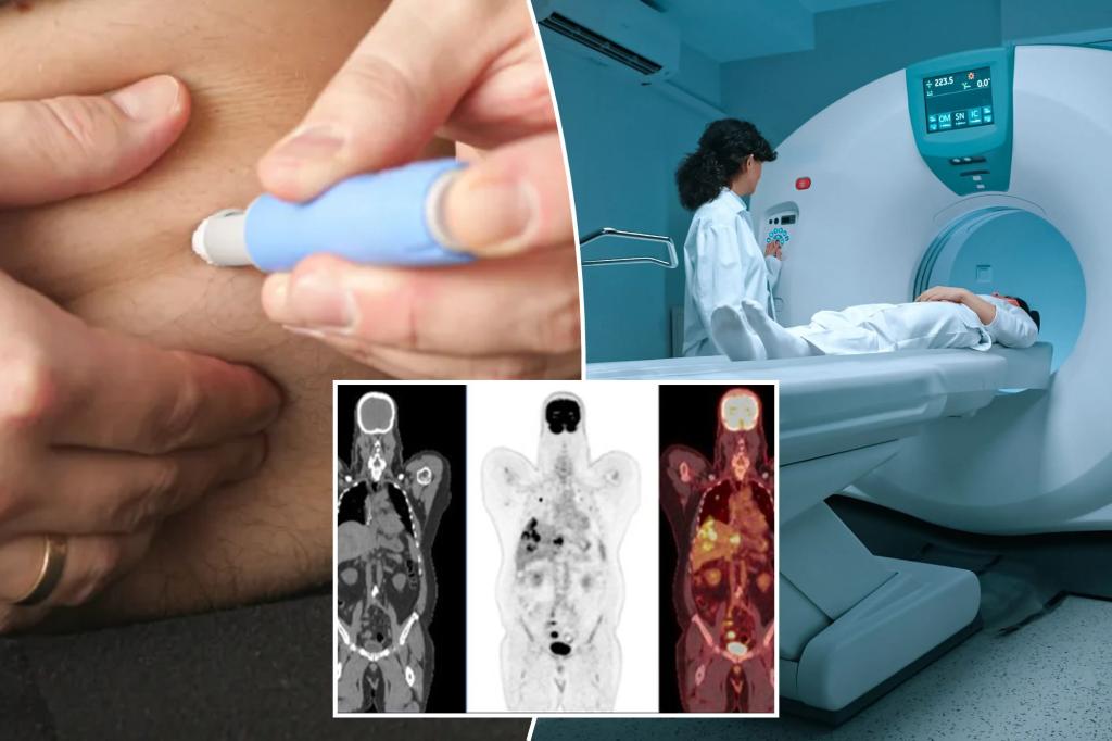 New 'unusual' side effect of GLP-1 drugs like Ozempic on the rise