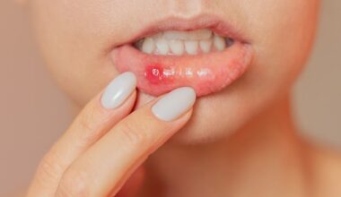 Mouth ulcers are breaks in the lining of the mouth, on the inner lips, inner cheeks or the tongue