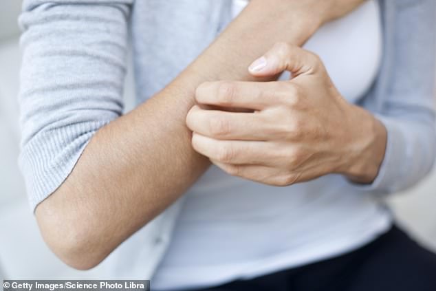 Wide-spread itching - known as generalised pruritus - can be caused by a number of factors