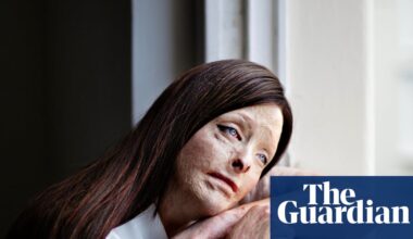 Image of burn survivor wins Taylor Wessing photo portrait prize | Taylor Wessing photographic portrait prize