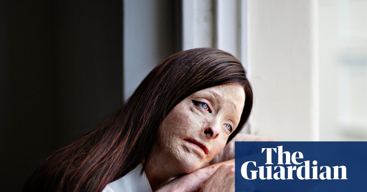 Image of burn survivor wins Taylor Wessing photo portrait prize | Taylor Wessing photographic portrait prize