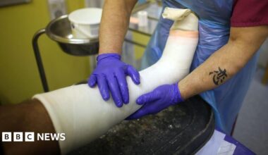 A leg, surrounded by a white cast is being held by a practitioner wearing purple plastic gloves.