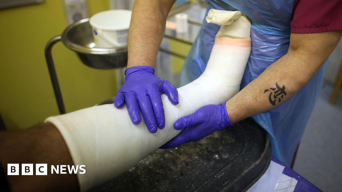 A leg, surrounded by a white cast is being held by a practitioner wearing purple plastic gloves.