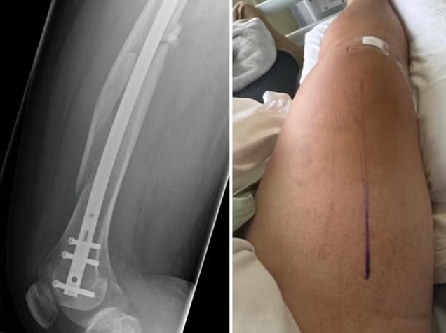 William Radford's injuries after leg break on Lime Bike