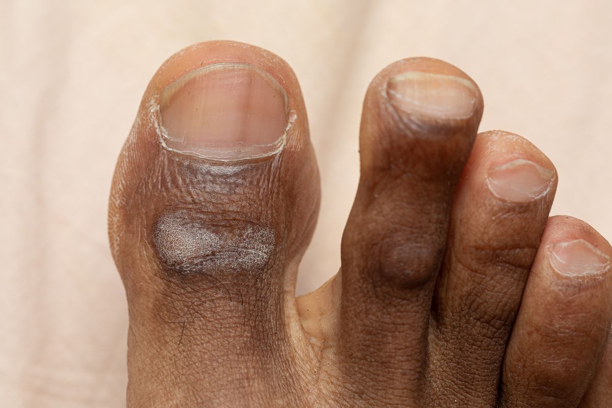 Close-up of toes exhibiting symptoms of athlete's foot, highlighting dry, flaky skin