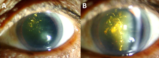 Eyes That Sparkle Like Christmas Trees Can Be a Rare Side-Effect of Aging
