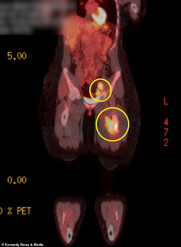 The circled sections in the above scan show tumors in Bailey's femur and groin