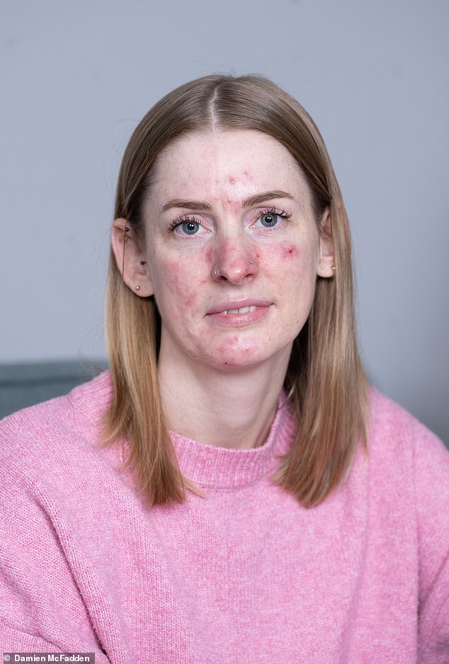 Rebecca Daley, 39, has struggled with rosacea since the birth of her first son in 2011