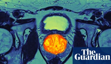 Weighing up the risks and benefits of prostate cancer screening | Prostate cancer