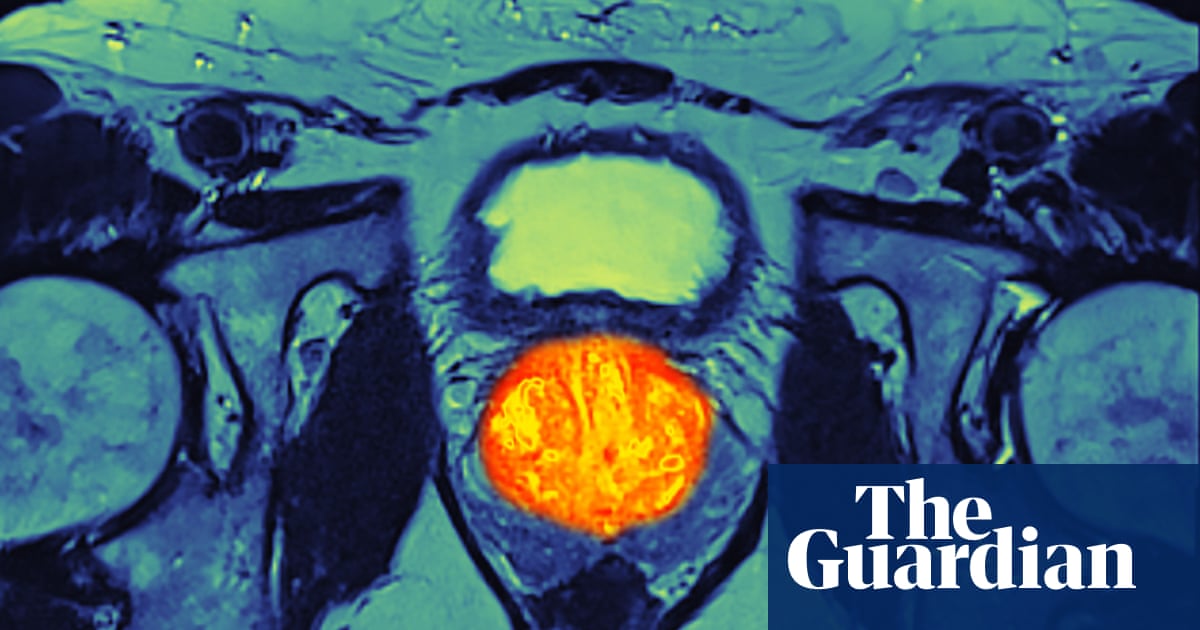 Weighing up the risks and benefits of prostate cancer screening | Prostate cancer
