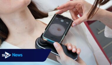 Remote diagnosis of skin conditions ‘could halve dermatology waiting lists’