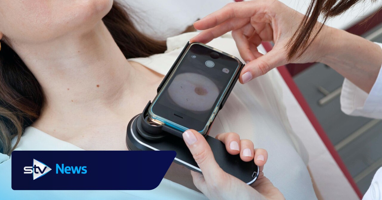 Remote diagnosis of skin conditions ‘could halve dermatology waiting lists’