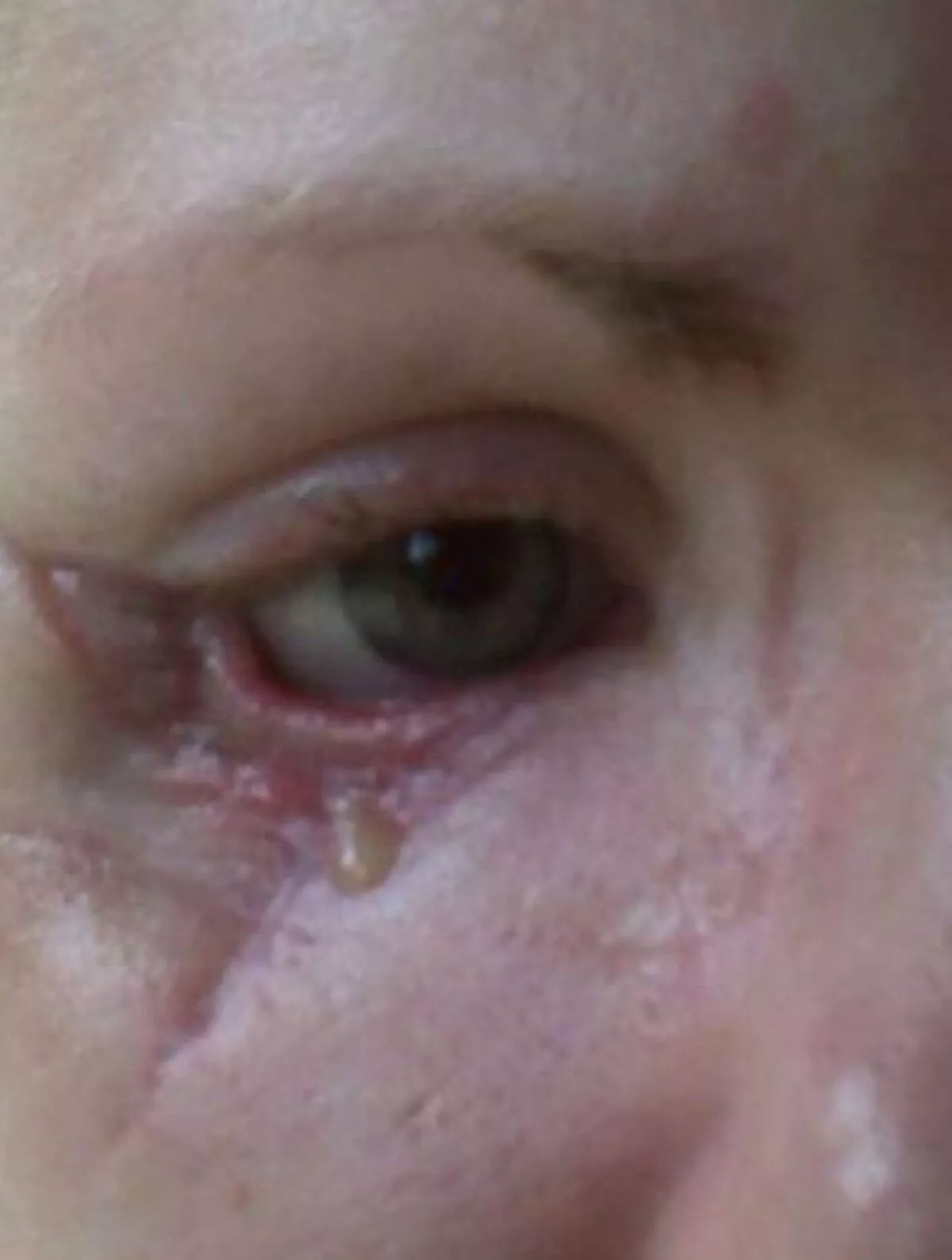 Pus leaking from Vanessa's face