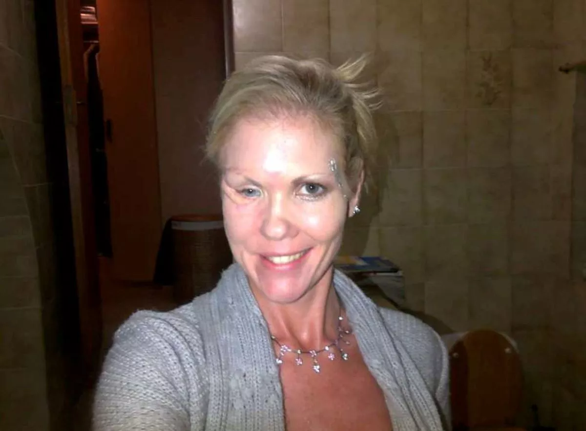 Vanessa post surgery after the infection was clearing