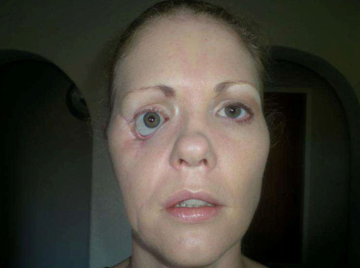 Vanessa after the removal of the infected cheek prosthetic