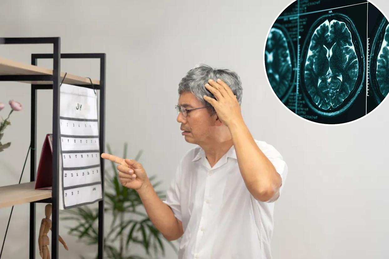 An image collage containing 2 images, Image 1 shows Senior Asian man with dementia looks confused while pointing at a calendar, Image 2 shows MRI scan of a human brain