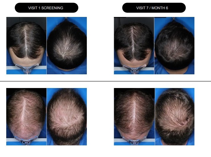 Cosmo Surges 40% on Baldness Candidate’s Phase III Data