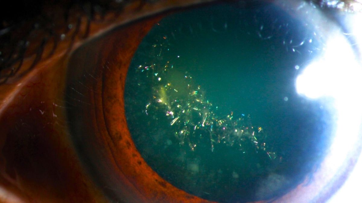 This Rare Condition Makes Your Eyes Sparkle Like a Christmas Tree : ScienceAlert